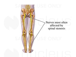 Spinal Stenosis