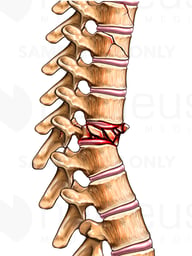 Spine Injury - Vertebral Compression Fracture