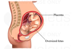 Gestational Diabetes
