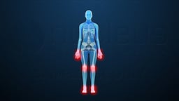 Rheumatoid Arthritis