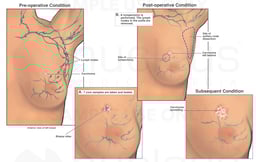 Attempted Lumpectomy- Progression of Breast Cancer