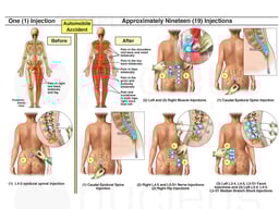 Pain Injections Before and After Accident