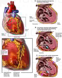 Ventricle Lacerations with Cardiac Tamponade