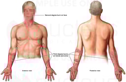 Second and Third Degree Burn Injuries