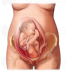 Bicornuate Uterus with Baby in Frank Breech Position