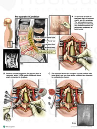 Lumbar Spine Injury with Surgical Decompression and Fusion