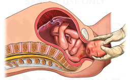 Birth Injury - Shoulder Dystocia with Brachial Plexus Injury Caused by Sacrum