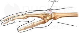Dorsal Wrist Ganglion