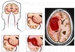 Rupture of Cerebral Aneurysm