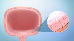 Treatment Options for Bladder Cancer