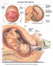 Vacuum Extraction with Fatal Head Injury