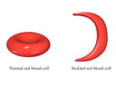 Sickle Cell Disease