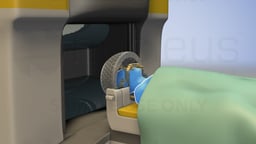 Gamma Knife (radiocirugía estereotáctica)