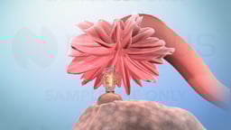 Understanding Ovarian Cancer