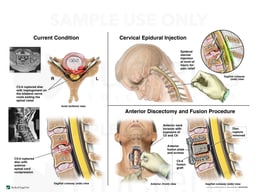 C5-6 Cervical Spine Injury with Epidural Injection and Anterior Discectomy and Fusion Procedure