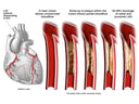 Anatomy of the Heart with Blockage of Coronary Artery