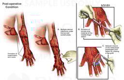 Hypertrophic Burn Scars and Revision Surgeries