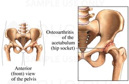 Osteoarthritis of the Hip Joint