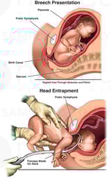 Breech Presentation with Head Entrapment of Infant