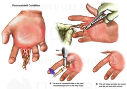 Degloving Injury of Right Third Finger with Surgical Amputation