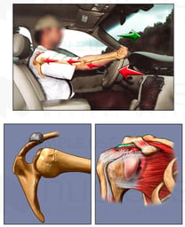 Mechanism of Shoulder Injury In Motor Vehicle Accident (MVA)