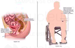 Medical Conditions Resulting from T12 Fracture