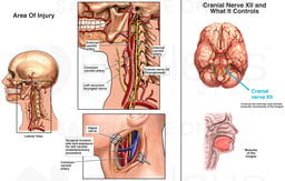Carotid Endarterectomy with Iatrogenic (Physician-related) Cranial Nerve Damage