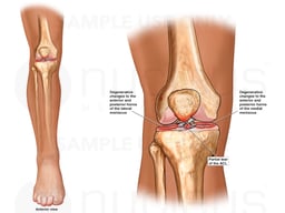Right Knee Injuries