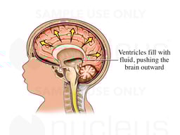 Congenital Hydrocephalus