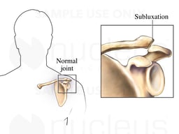Acromioclavicular Subluxation