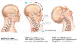 Interpretation of Whiplash Mechanics from Grauer et al. (Spine, 1997)