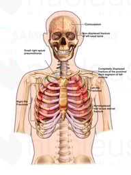 Multiple Traumatic Injuries