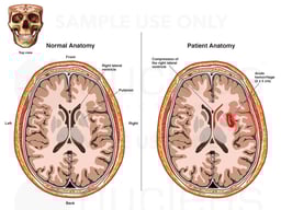Intracranial Hemorrhage