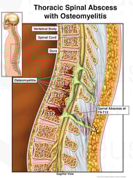 Thoracic Spinal Abscess with Osteomyelitis