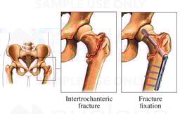 Intertrochanteric Hip Fracture with Fixation Device