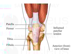 Patellar Tendonitis