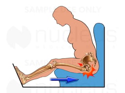 Mechanism of Left Hip Injury