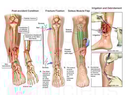 Right Lower Leg Injury with Multiple Surgeries