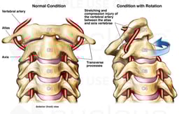 Rotational Injury of the Vertebral Artery