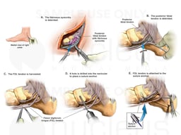 Tendon Debridement and Tendon Transfer