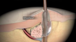 Types of Acne: Whitehead