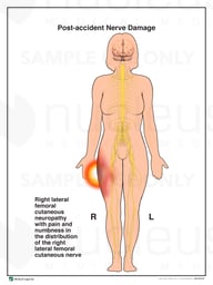 Female Silhouette with Post-accident Nerve Damage