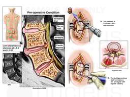 Lumbosacral Spine Injuries with Surgical Discectomy