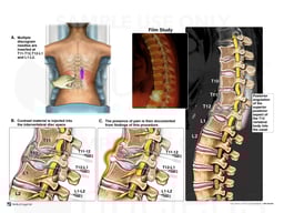 Thoracic and Lumbar Discograms