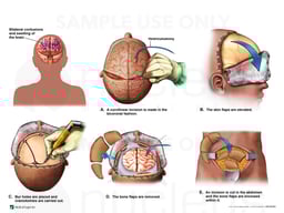 Brain Injury with Frontal and Bilateral Craniotomies