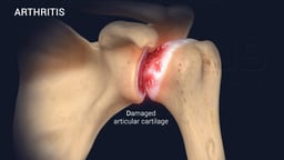 Arthritis in the Shoulder Joint with Damaged Articular Cartilage