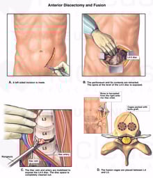 L4-5 Anterior Discectomy and Spinal Fusion Procedures