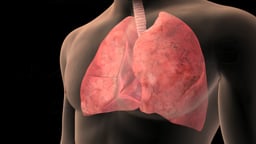 Lung Cancer Symptoms