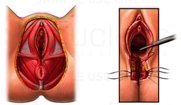 Third Degree Episiotomy Tear with Surgical Repair