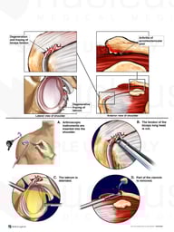 Continued Shoulder Issues with Third Arthroscopic Repair Procedure